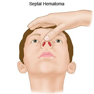Fractured on sale nose symptoms