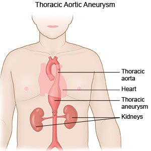 Thoracic Aortic Aneurysm 