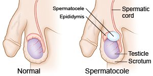 Normal/Spermatocele