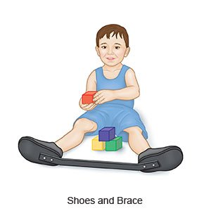 Clubfoot Brace