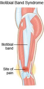 Exercise Program for IT Band Syndrome