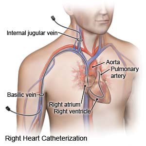 Right Heart Catheterization
