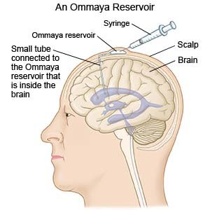 Ommaya Reservoir