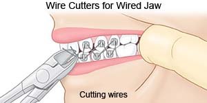 Wire Cutters for Wired Jaw
