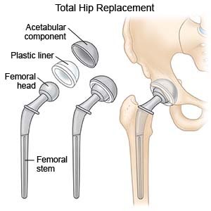 What Is a Hip Replacement?