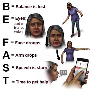 BE FAST SIGNS OF A STROKE