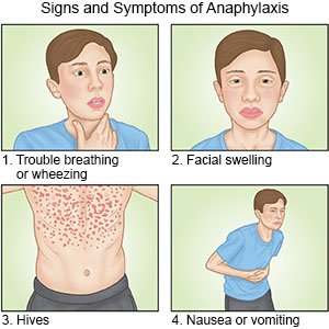 Signs and Symptoms of Anaphylaxis 