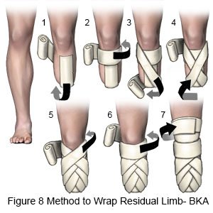 Residual Limb Wrap BKA