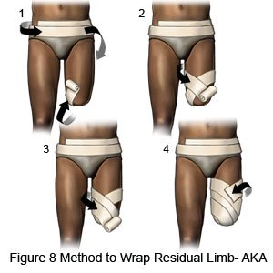 Residual Limb Wrap AKA