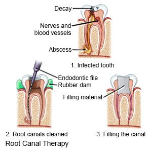 Root Canal