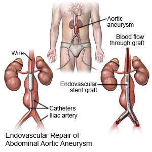 Abdominal Aortic Aneurysm Repair