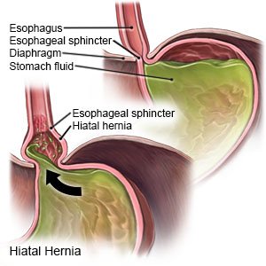 Hiatal Hernia