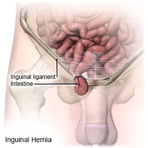 Meaning hernia Hernia Definition