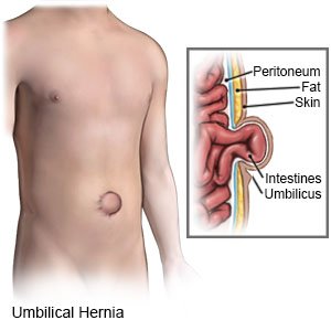 Umbilical Hernia (swollen belly button) - How to tell if you have one