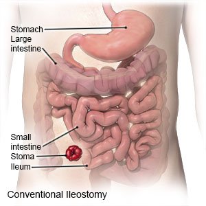 Conventional Ileostomy 