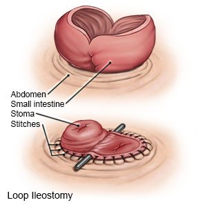 Loop Ileostomy