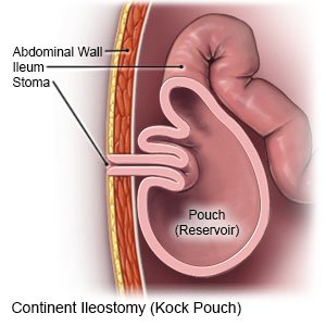 Continent Ileostomy