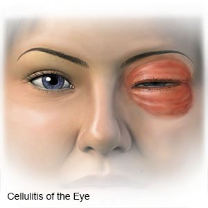 What are the signs and symptoms of periorbital cellulitis?