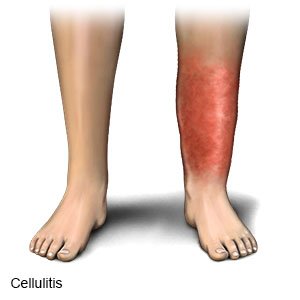 Cellulitis What You Need To Know
