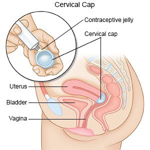 Cervical Cap