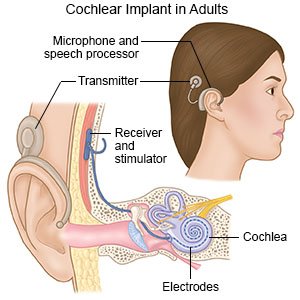 Cochlear Implant in Adults