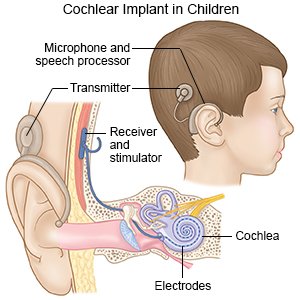 Cochlear Implant in Children