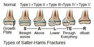 Salter-Harris Fractures