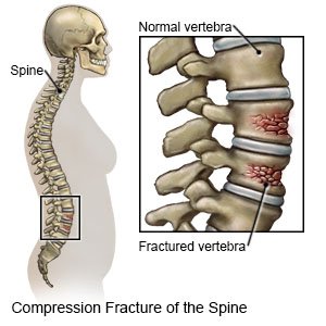 Compression Fracture of Spine