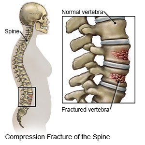 Vertebral Compression Fracture - What You Need to Know