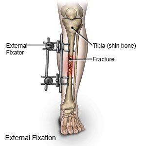 External Fixation Device