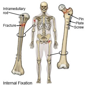 Internal Fixation Device