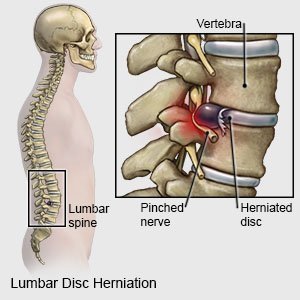 Terapii alternative pentru hernia de disc | Click