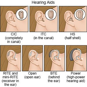 Types of Hearing Aids