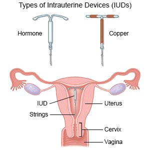 Types of IUDs