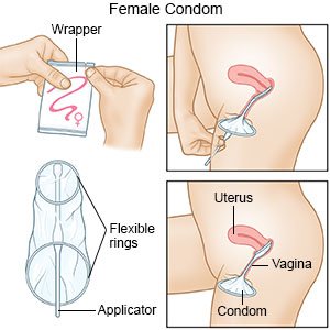 Female Condom Use - What You Need to Know