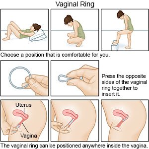 Vaginal Ring