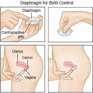 Image result for diaphragm contraceptive