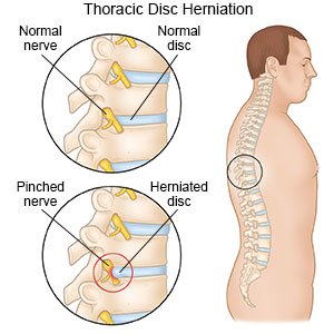 Thoracic Disc Herniation