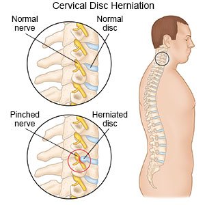 Herniated Disc - Causes, Symptoms & Treatment