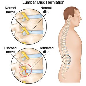 Lumbar Disc Herniation