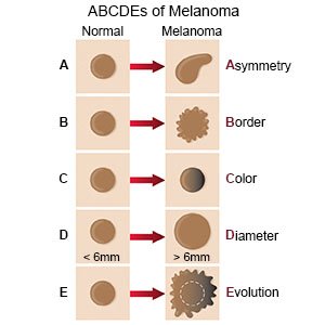 Melanoma ABCDE