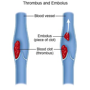 Thrombus and Embolus