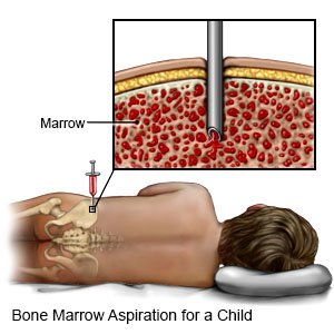 Bone Marrow Aspiration