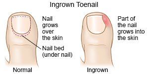 Ingrown Toenail Treatment Near Me in Tustin, CA | Tustin Podiatry Clinic
