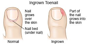 Ingrown Toenail