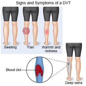 DVT Signs and Symptoms
