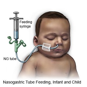 NG Tube Feeding (Infant) 