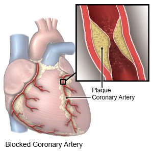 Blocked Coronary Artery