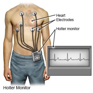 Holter Monitor