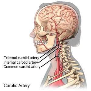 Carotid Artery Disease What You Need To Know